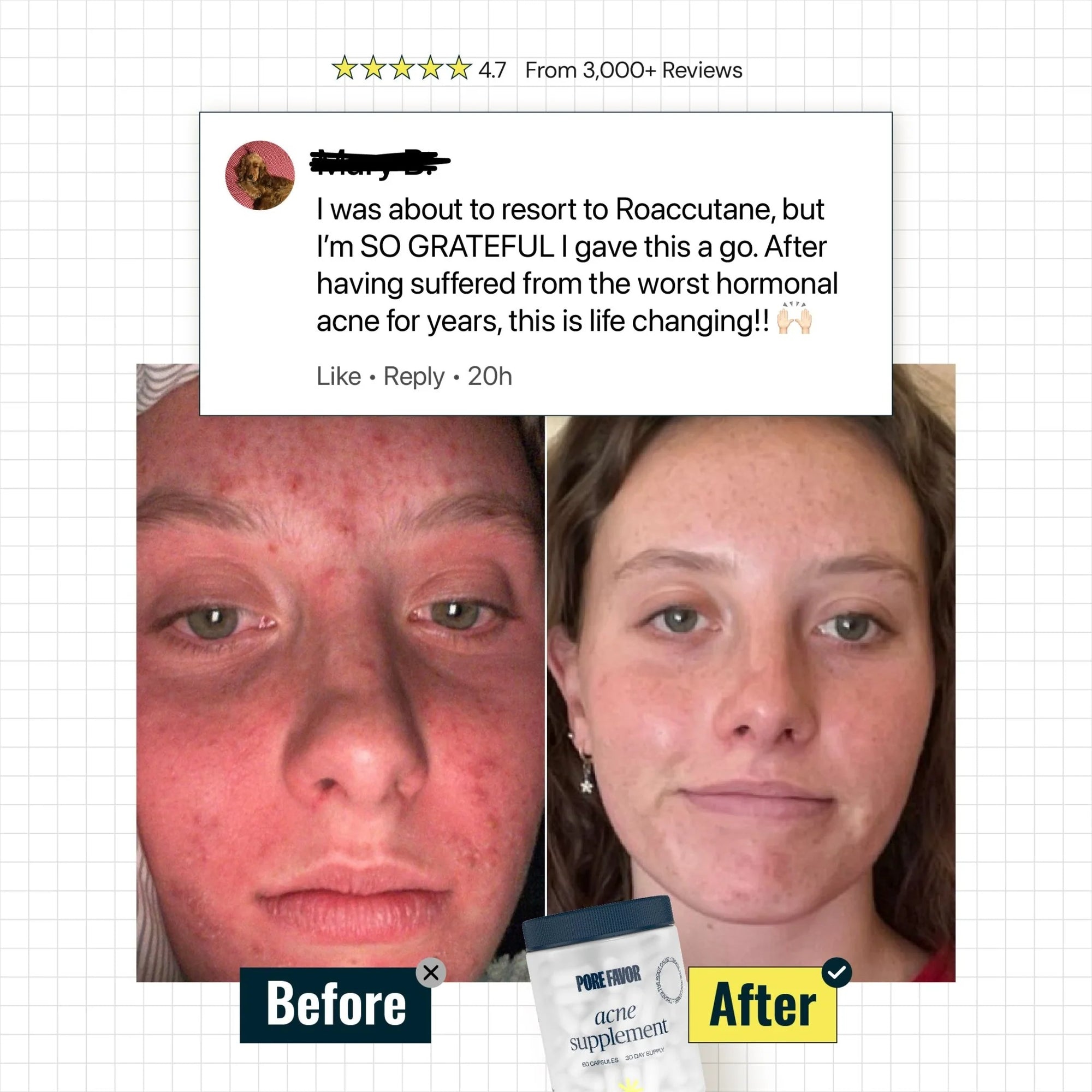 The Acne Supplement